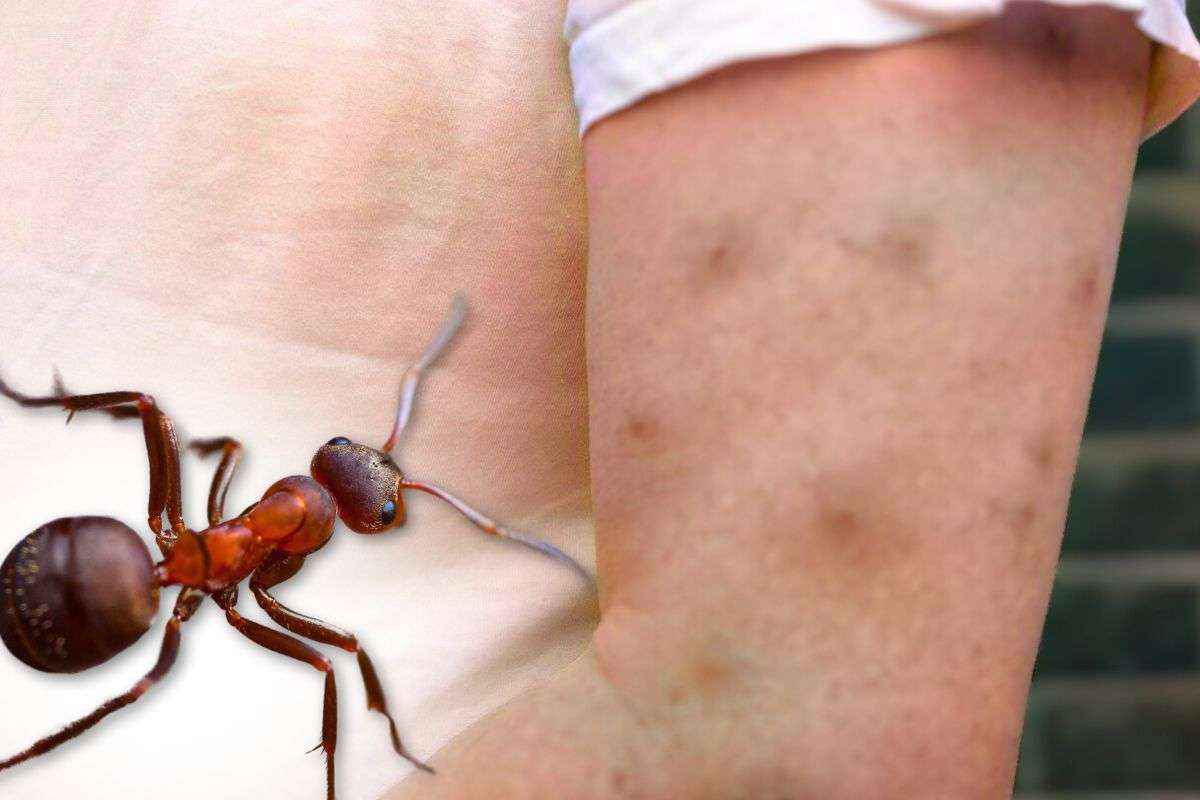 Punture formiche: sintomi